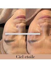 シエルエトワレ/CIVASAN シルク肌コース