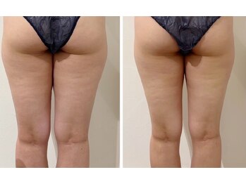 メディカルエース(MedicalAce)/痩身　看護師ボディ　ハイサーマ