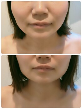 サロンドットブレスドットケイ(salon.bless.k)/小顔フェイシャル