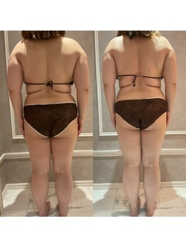 ナルシス(Narcissus)/インディバ90分3ヶ月モニター