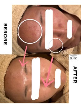 ポノ(PONO)/水光ピーリング