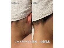 サラ 恵比寿店(SARA)/フォトRF うなじ脱毛