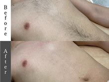 メンズオージー 岡山中区(men's O.G)/メンズ脱毛｜胸&腹&へそ下脱毛