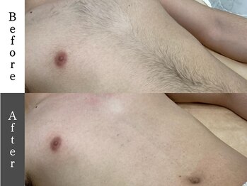 メンズオージー 岡山中区(men's O.G)/メンズ脱毛｜胸&腹&へそ下脱毛