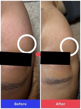 プーモア(Puu Moa)/リアージュしみケア4回目