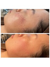 MMK/光フェイシャルでシミケア