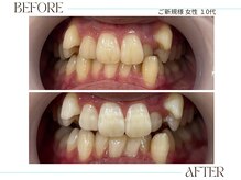 ホワイトニングサロンブライト 尼崎店(Whitening salon bright)/ご新規様のbefore/after