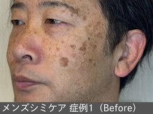 オアシスラグーン(OASIS LAGOON)/メンズシミケア（症例1 before）