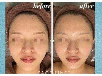 シンメトリー 銀座店/小顔美筋コルギ リフトアップ