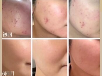 ミソル(misolle.)/剥離ハーブ 6回の経過