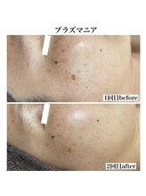 サロン ルシェリア(Salon Le cherien)/美肌マシーンプラズマニア