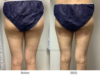 スラリ(SLARI)/【太もも脂肪冷却】期間1か月半