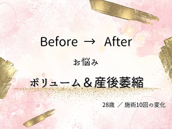 ロットプラス(Lot Plus)/バストアップ症例【C→Fカップ】