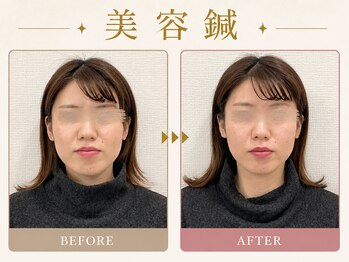 メモラ(memola)/美容鍼【BeforeAfter】