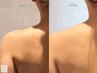【ブライダル】最新ウィンバックback4最速結果出し二の腕/背中/首デコルテ
