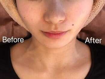 リフト 飯田橋(Lift)の写真/【顔のもたつきを撃退】マイクロ波使用の韓国式小顔マシンで美シルエットへ！結果重視の最新小顔術♪