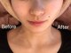 リフト 飯田橋(Lift)の写真/【顔のもたつきを撃退】マイクロ波使用の韓国式小顔マシンで美シルエットへ！結果重視の最新小顔術♪