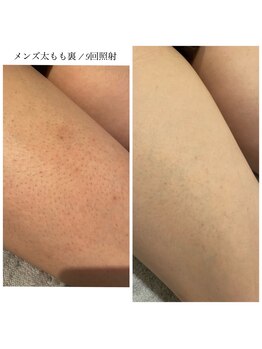 エクラ(eclat)/メンズ足脱毛