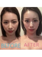 マホロバ(mahoroba)/美容鍼＋オイルマッサージ