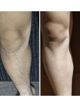 シエル ブルー(Ciel Blue)/メンズ脱毛