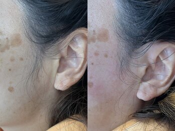 リコ バイ グラス(Rico by GRASS)/もみあげ