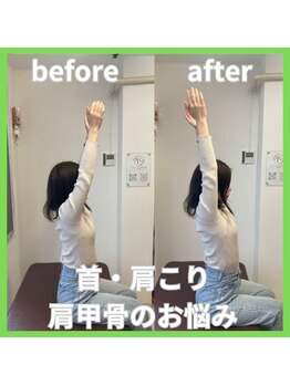 とるこり美姿整体院 新宿院/ 20代女性-猫背矯正Before/After