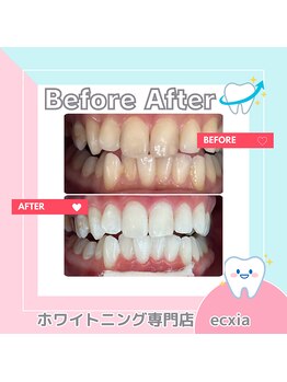 エクシアホワイトニング 札幌中島公園店/BeforeAfter［ホワイトニング］ 