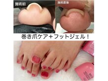 サンカリネイル バイ ヴァラ 新居浜 船木店(sankari nail by VALLA)の雰囲気（しっかり巻き爪でお悩みの方！一度ご相談ください。）