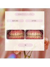 プラスビーセルフ(+b self)/ホワイトニングビフォーアフター