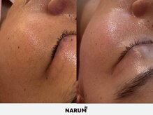 ナルムフェイシャル 代々木(NARUM facial)/水光ピーリング