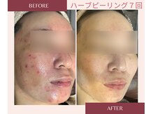 アブニールブリヨンの雰囲気（剥けるハーブはニキビの鎮静、ニキビケアが大得意！◎[肌質改善]）