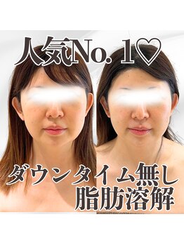 ミタメ 銀座店(MITAME)/下膨れのお悩みにも♪脂肪燃解