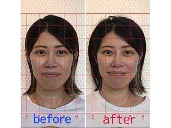 ルディア 堂島店(ledia)/西梅田美容鍼1回での変化