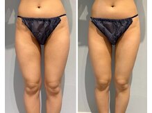 メディカルエース(MedicalAce)/痩身　看護師ボディ　ハイサーマ