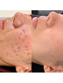 ビーエスアクアビューティー/ハイドラ＋ハーバルピーリング