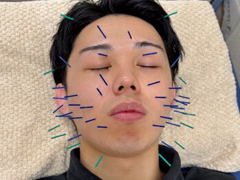 あすか鍼灸整骨院 アスカボディファクトリー(ASUKABodyFactory)/男性にも美顔鍼で清潔感UP!