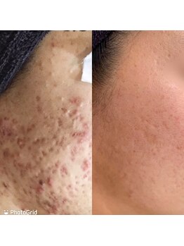 サロン ド ビューティージュエル(salon de beauty JEWEL)/劇的進化ハイスピードハーブ