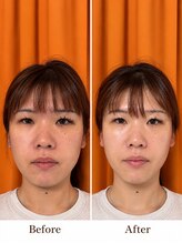 ブプラ 防府店(BUPURA)&nbsp;お悩みNo.1 小顔ケア