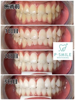 ホワイトベース(White Base)/before after