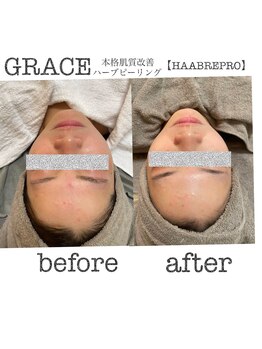 グレース(GRACE)/ハーブピーリング/HAABREPRO