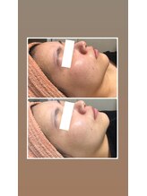 オアジスパ(Oasi Spa)/フラッシュピール