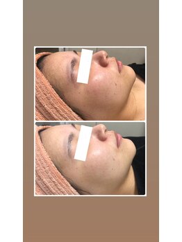 オアジスパ(Oasi Spa)/フラッシュピール