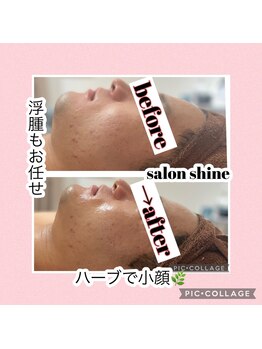 サロンシャイン(Salon Shine)/REVI]ハーブ２０代男性