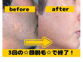 ボディステップ 調布(BODYSTEP)/顔脱毛