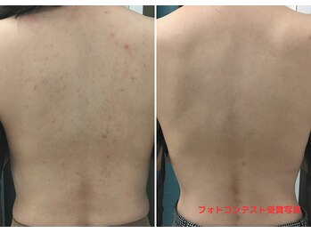 イヨヨ(iyoyo)/BeforeAfter