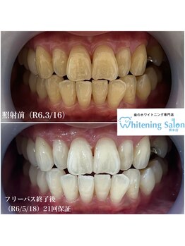 ホワイトニングサロン 熊本店/学生さんもホワイトニング可