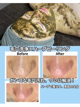 脱毛マックス 南越谷店(MAX)の写真/《毛穴汚れ除去＋ハーブピーリング》で肌格上げ☆毛穴の角栓詰まり解消&ハーブで皮脂抑制◎夏の化粧崩れに!