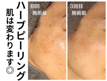 エリン(ERIN)/ハーブピーリング　3回目