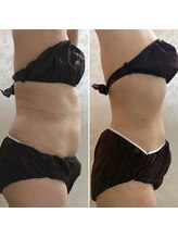 ビューティービューティー(beauty×beauty)/お腹は脂肪冷却！