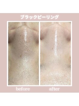 アネーロ(anhelo)/ブラックピーリング！